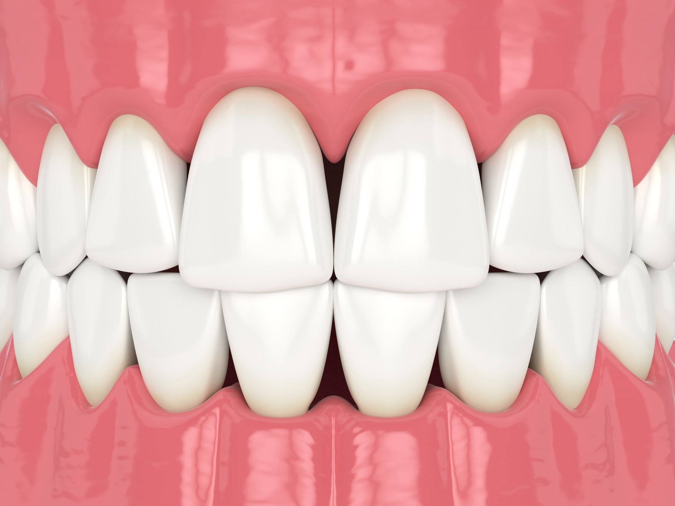 Dark Triangle/Diastema Dark Triangle/Diastema