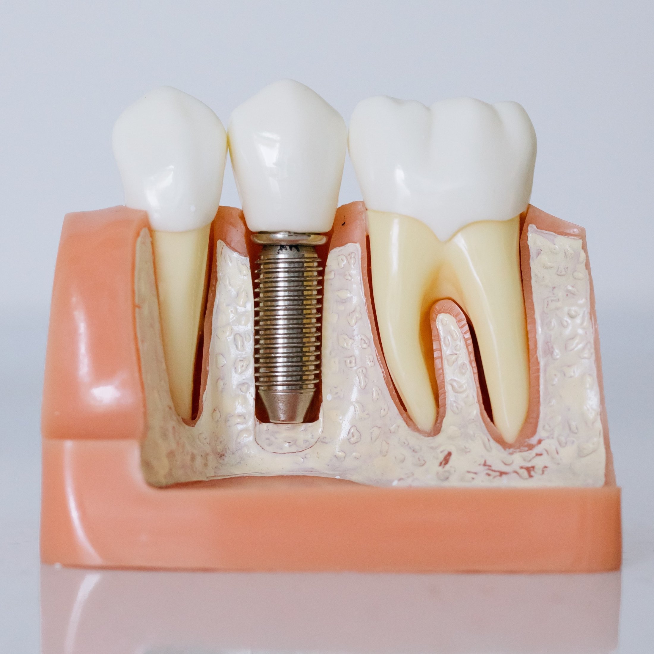 Dental Implants Dental Implants